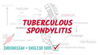 Tuberculous Spondylitis Overview and Treatment [upl. by Karalynn612]