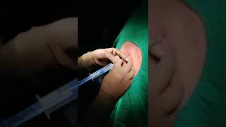 Epidural Catheter Insertion technique [upl. by Aihseket]