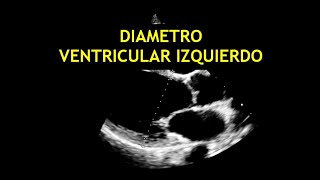 Como medir los DIAMETROS DEL VENTRICULO IZQUIERDO Ecocardiografia [upl. by Nyad]