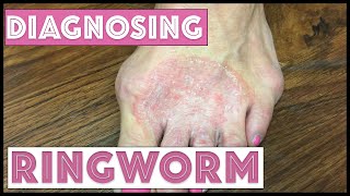 How we diagnose Ringworm Tinea Corporis [upl. by Peria797]