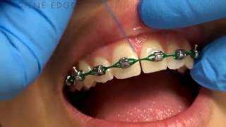 Flossing Braces With a Threader [upl. by Olra999]