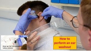 How to Perform an Ear Washout irrigation  ENTOtolaryngology Skills [upl. by Chuu]