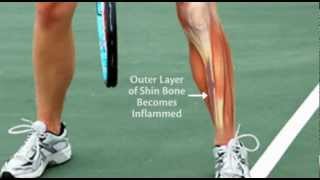 Do You Suffer From Shin Splints [upl. by Humphrey]