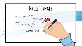 How to Remove a Mallet Finger Splint SAFELY [upl. by Ardnuaed894]