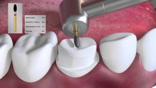 Crown preparation tutorial by Prof Brian Millar [upl. by Phoebe]