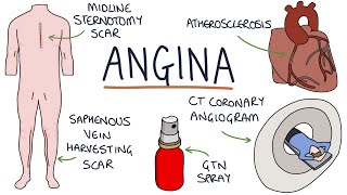 Understanding Angina Visual Explanation for Students [upl. by Annawad]