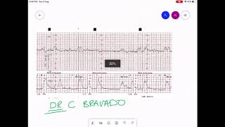 CARDIOTOCOGRAPHY  CTG INTERPRETATION [upl. by Enneyehs]