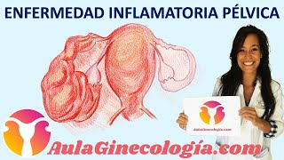 ENFERMEDAD INFLAMATORIA PÉLVICA EPI Síntomas y tratamiento  Ginecología y Obstetricia [upl. by Anitsirc149]