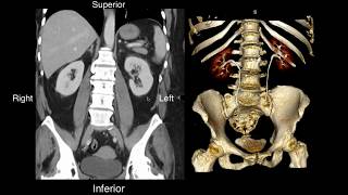 Normal Renal Anatomy [upl. by Eizzil249]