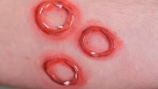 DISGUSTING RINGWORM [upl. by Warden979]