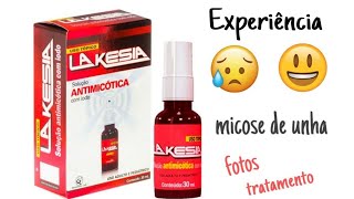 Tratamento com LAKESIA para micose nas unhas minha experiência [upl. by Aikrehs689]