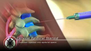 Cervical Epidural Steroid Injection Procedure Animation [upl. by Leila652]