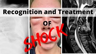 Recognition and Treatment of Shock [upl. by Anytsirk]