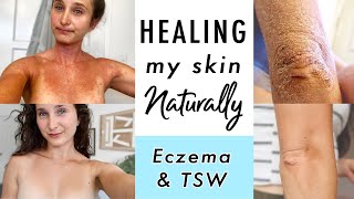 How I CURED Eczema amp Topical Steroid Withdrawal NATURALLY  My Skin Healing Journey [upl. by Tiny]