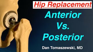 Anterior Vs Posterior Hip Replacement [upl. by Candless754]