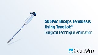 SubPec Biceps Tenodesis Using TenoLok®  CONMED Animation [upl. by Yortal]