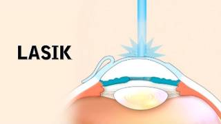 How LASIK Eye Surgery Is Performed [upl. by Robbert544]