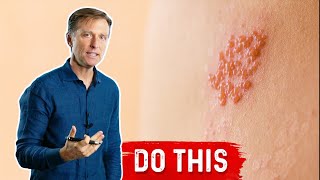 How to Deal With Ringworm Naturally [upl. by Llieno]