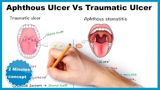 Aphthous ulcerstomatitis Vs Traumatic ulcer [upl. by Birdie]