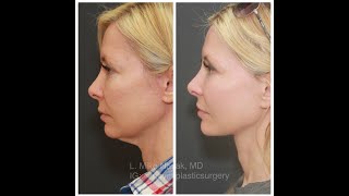 The Truth about Face and Neck Lift Incisions [upl. by Malinin]