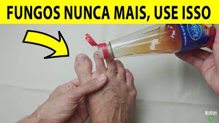 O FIM DA MICOSE E FUNGOS NAS UNHAS Basta 5 Gotas Disso Para Eliminar em 3 Dias [upl. by Aihpos374]