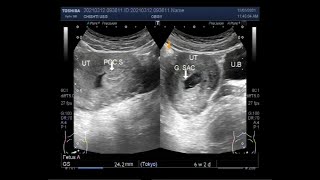 Ultrasound Video showing Incomplete abortion [upl. by Stickney643]