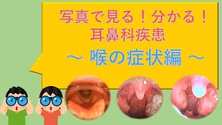 喉の痛み、喉の違和感、咳や発熱の原因はコレかも！？写真で分かりやすい！耳鼻科疾患～喉の症状編～ [upl. by Nema]