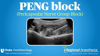 PENG Block Pericapsular Nerve Group Block [upl. by Eemak]