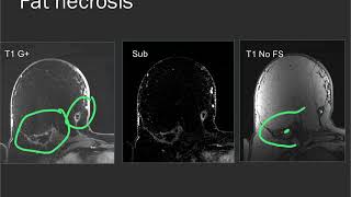 Breast MRI  common findings and cases [upl. by Iv775]