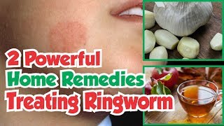 2 Powerful Home Remedies For Treating Ringworm [upl. by Uela497]