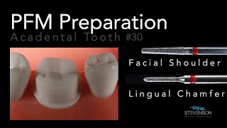 PFM Preparation  Acadental Tooth 30  Dr Richard Stevenson [upl. by Arihk996]