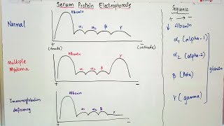 Serum Protein Electrophoresis importance and result interpretation in an easy way [upl. by Aelem468]