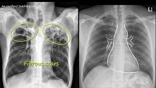 Chest x ray  Tuberculosis healed TB Inactive TB [upl. by Fronnia]