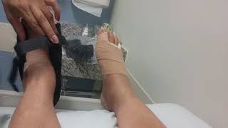 JOANETE  Minha cirurgia 3o diavídeo 14  HALLUX VALGUS OU HÁLUX VALGO [upl. by Picco]