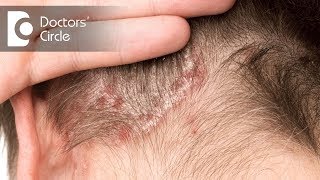 Treatment options for Scalp Psoriasis  Dr Rashmi Ravindra [upl. by Ennoval8]