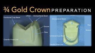 34 Gold Crown Preparation  Maxillary Premolar [upl. by Iot]