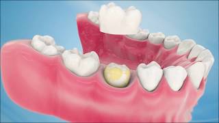 Dental Crown Procedure [upl. by Elinad]