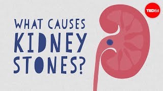 What causes kidney stones  Arash Shadman [upl. by Alios606]