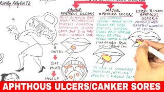 Aphthous Ulcers  Canker Sores  Pathophysiology Triggers Types amp Treatment [upl. by Gosser925]