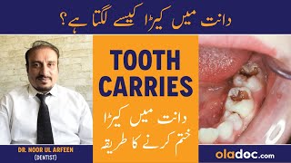 TOOTH DECAY TREATMENT  Dant Me Kida Lagne Ka Ilaj  Tooth Carries  How To Remove Cavity From Teeth [upl. by Yran604]