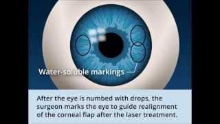 Lasik Surgery Things You Need To Know [upl. by Manup410]