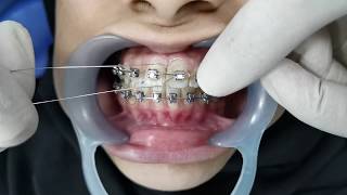 Orthodontic Ligation [upl. by Ajiam]