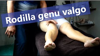 Rodilla en genu valgo [upl. by Cairns]