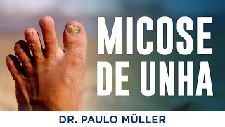 Micose de Unha  Dr Paulo Müller Dermatologista [upl. by Eaves]