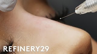 Why I Got This 15 Minute Nose Job  Macro Beauty  Refinery29 [upl. by Kulda]