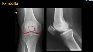 Anatomía Rx Rodilla [upl. by Shumway]