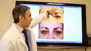 Dr Kotlus tells how to fix a droopy eyelid [upl. by Odlaw]