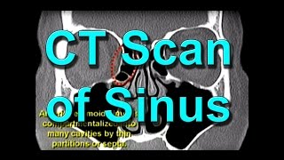 How To Read CT Sinus Scans Like An Expert [upl. by Ahcsatan50]