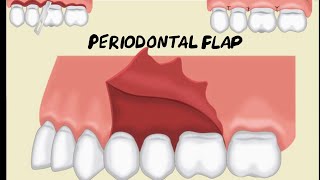 Periodontal Flap [upl. by Enelyam]