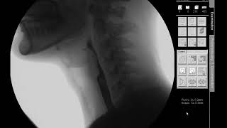 Nectar Thick Liquids  Modified Barium Swallow Study MBSS Lateral View HD [upl. by Pine]